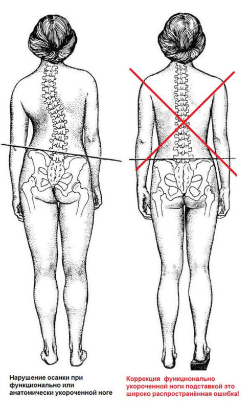 Одна нога короче другой на 1 см у взрослого