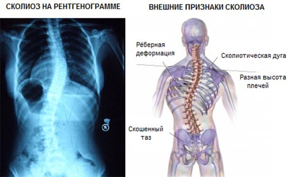 Стадии сколиоза позвоночника фото