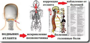 О коррекции Атланта (первого шейного позвонка)