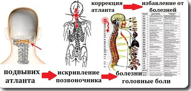 Что такое подвывих атланта?