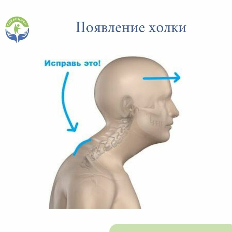 Холка у человека где находится фото