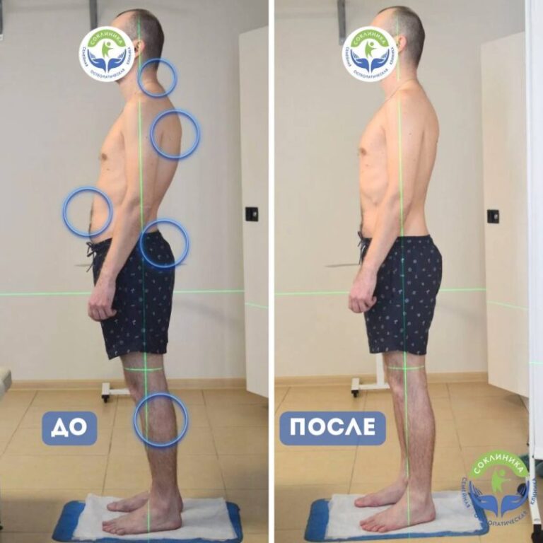 СОКЛИНИКА - Семейная Остеопатическая клиника 11 Посмотрите, каких результатов, по возможности иметь правильное положение тела, мы добиваемся уже на первом приёме💚